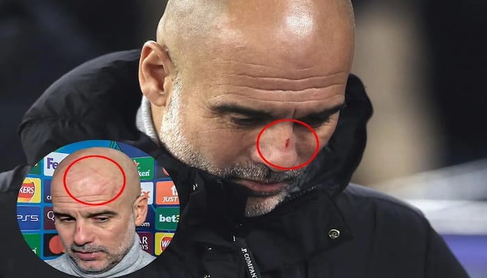 Guardiola Clarifies Self-Harm Comments After Post-Match Joke About Scratches on His Face